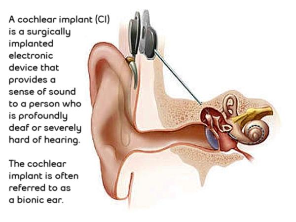 cochlear-implant.jpg